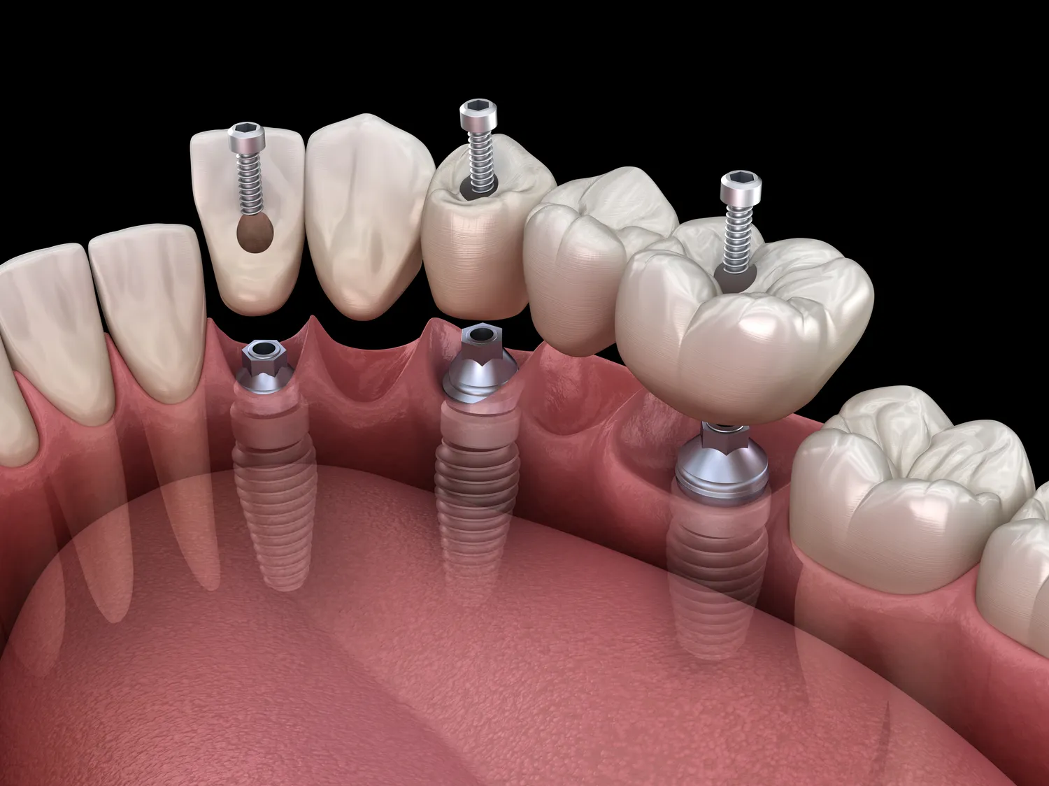 Implanty dentystyczne Szczecin